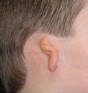 microtia-3-grado