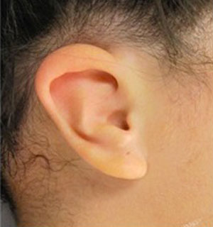 microtia-grado-1