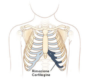 rimozione-cartilagine